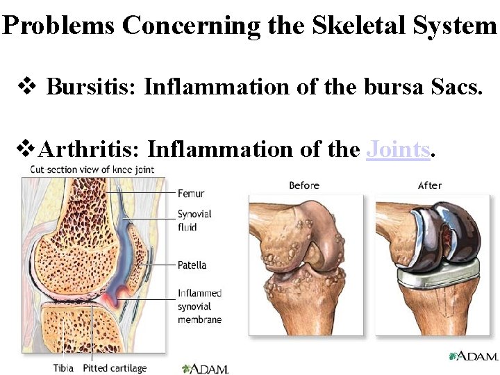 Problems Concerning the Skeletal System v Bursitis: Inflammation of the bursa Sacs. v. Arthritis: