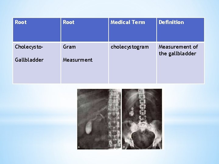 Root Medical Term Definition Cholecysto- Gram cholecystogram Measurement of the gallbladder Gallbladder Measurment 