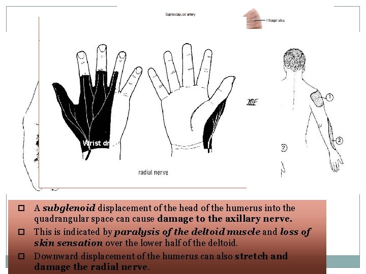 27 Wrist drop A subglenoid displacement of the head of the humerus into the 27 Wrist drop A subglenoid displacement of the head of the humerus into the