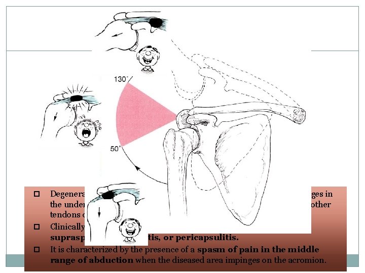 37 Degenerative changes in the bursa are followed by degenerative changes in the underlying