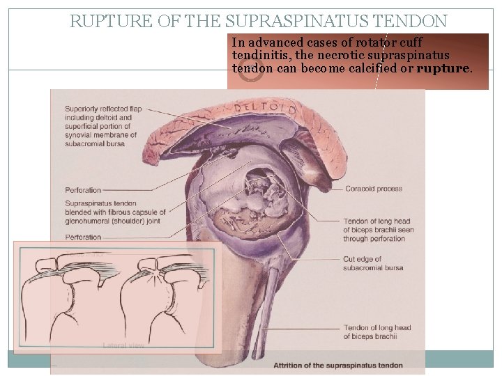 RUPTURE OF THE SUPRASPINATUS TENDON In advanced cases of rotator cuff tendinitis, the necrotic