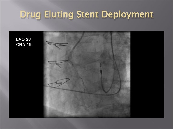 Drug Eluting Stent Deployment LAO 28 CRA 15 Drug Eluting Stent Deployment LAO 28 CRA 15