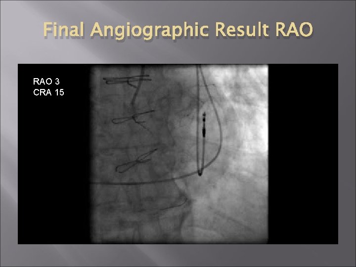Final Angiographic Result RAO 3 CRA 15 Final Angiographic Result RAO 3 CRA 15