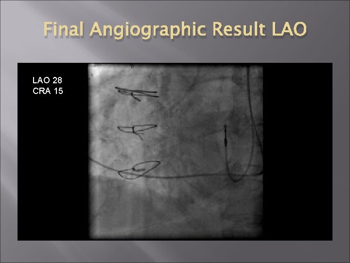 Final Angiographic Result LAO 28 CRA 15 Final Angiographic Result LAO 28 CRA 15