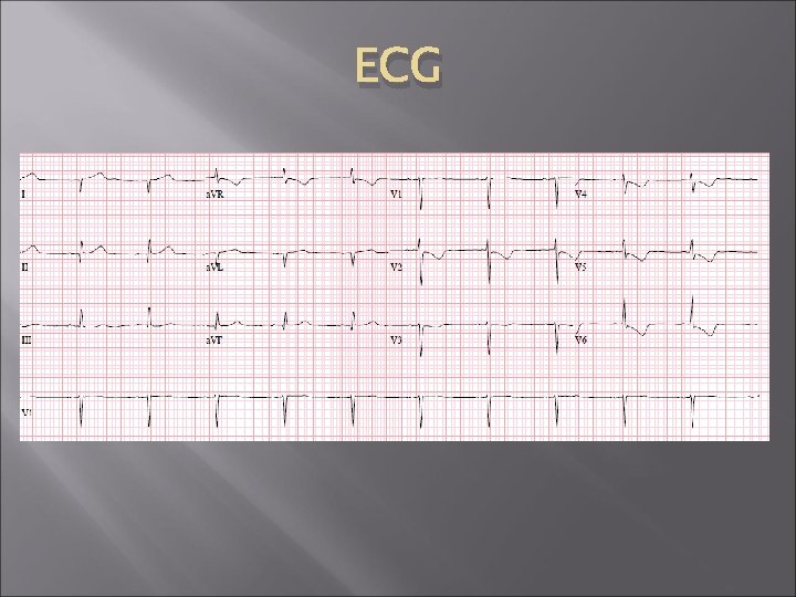 ECG ECG