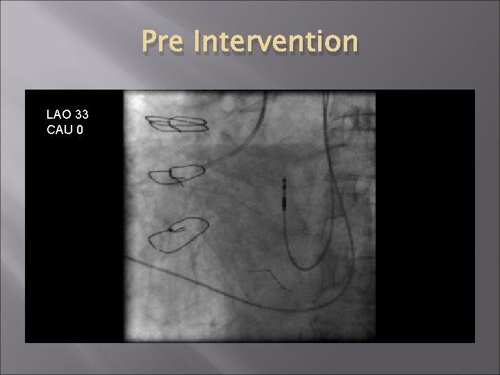 Pre Intervention LAO 33 CAU 0 Pre Intervention LAO 33 CAU 0