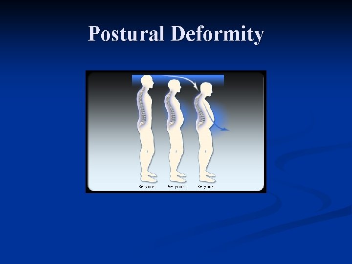 Postural Deformity 