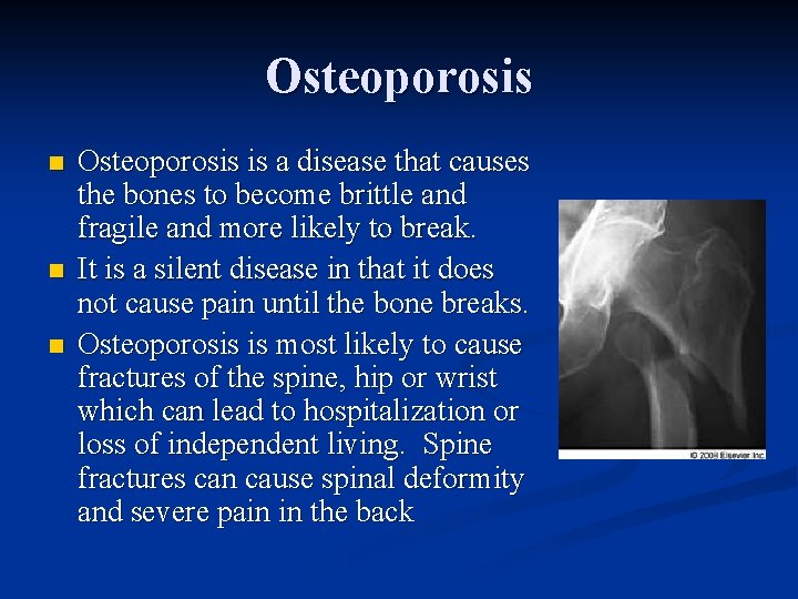 Osteoporosis n n n Osteoporosis is a disease that causes the bones to become