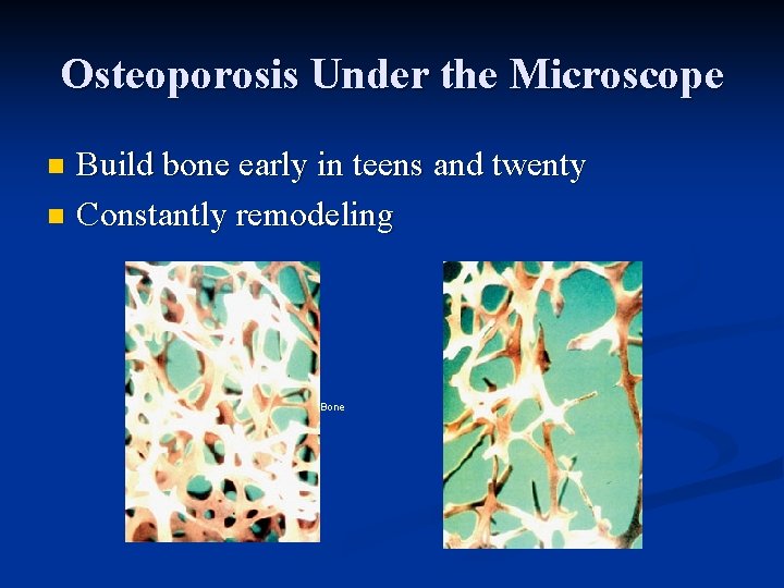 Osteoporosis Under the Microscope Build bone early in teens and twenty n Constantly remodeling