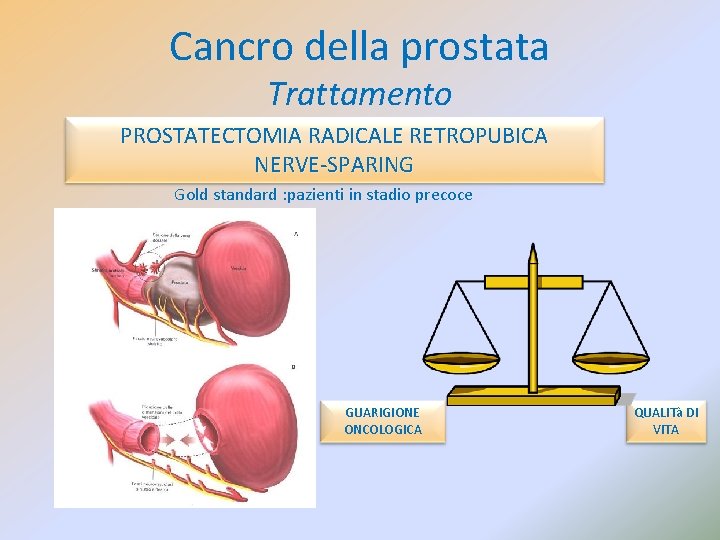 Cancro della prostata Trattamento PROSTATECTOMIA RADICALE RETROPUBICA NERVE-SPARING Gold standard : pazienti in stadio