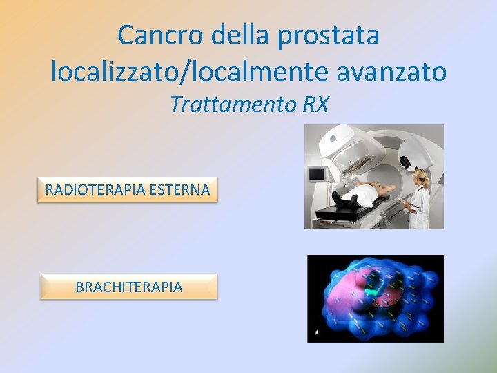 Cancro della prostata localizzato/localmente avanzato Trattamento RX RADIOTERAPIA ESTERNA BRACHITERAPIA 