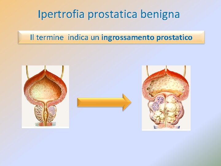 Ipertrofia prostatica benigna Il termine indica un ingrossamento prostatico 