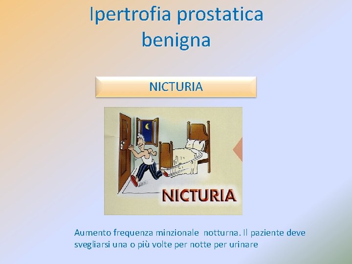 Ipertrofia prostatica benigna NICTURIA Aumento frequenza minzionale notturna. Il paziente deve svegliarsi una o