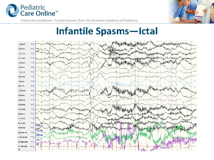 Treat with confidence. Trusted answers from the American Academy of Pediatrics. Infantile Spasms—Ictal 