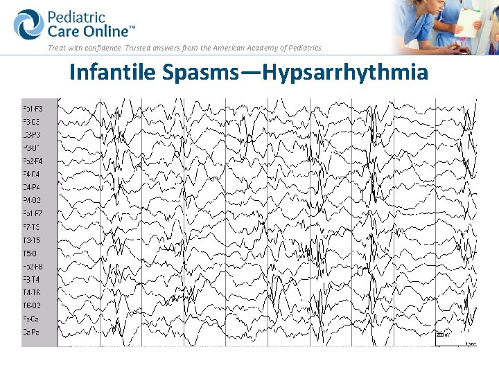 Treat with confidence. Trusted answers from the American Academy of Pediatrics. Infantile Spasms—Hypsarrhythmia 