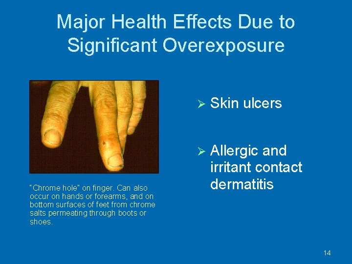 Major Health Effects Due to Significant Overexposure Skin ulcers Allergic and “Chrome hole” on