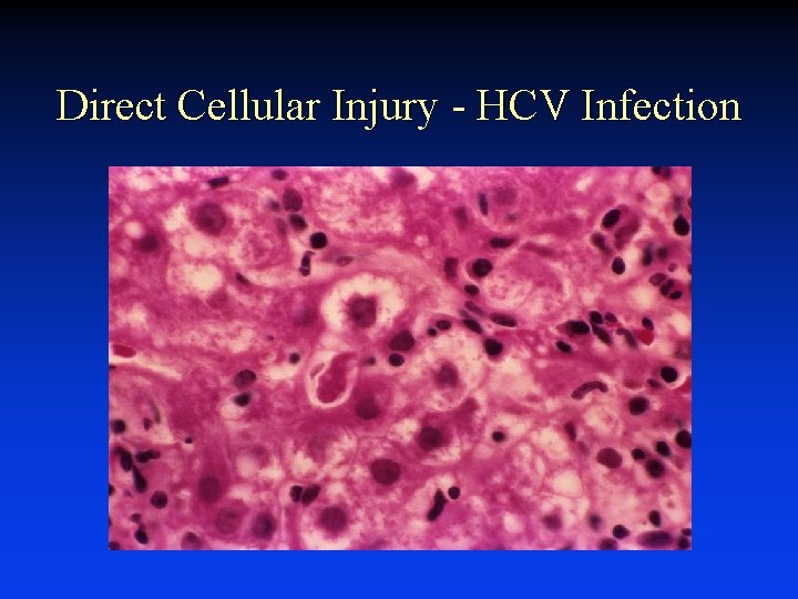 Direct Cellular Injury - HCV Infection 