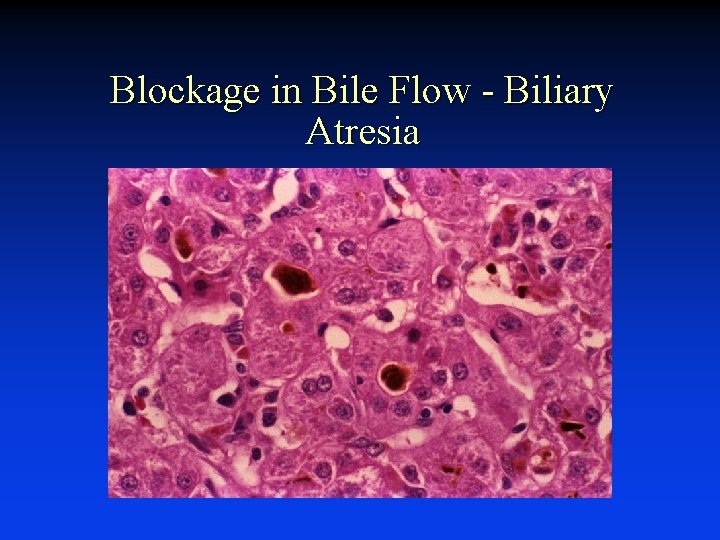 Blockage in Bile Flow - Biliary Atresia 