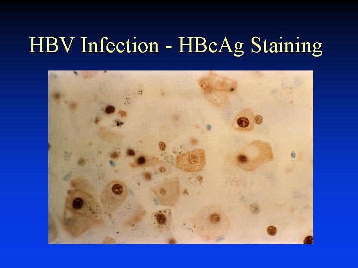 HBV Infection - HBc. Ag Staining 