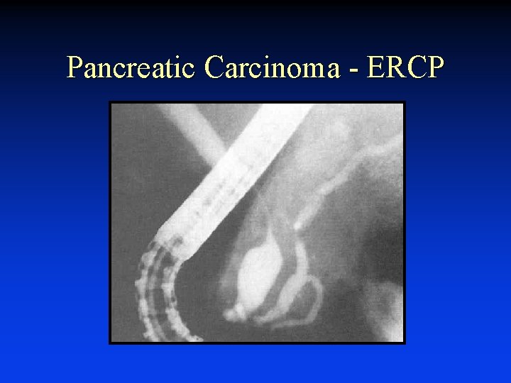 Pancreatic Carcinoma - ERCP 