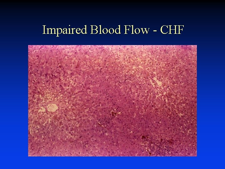 Impaired Blood Flow - CHF 