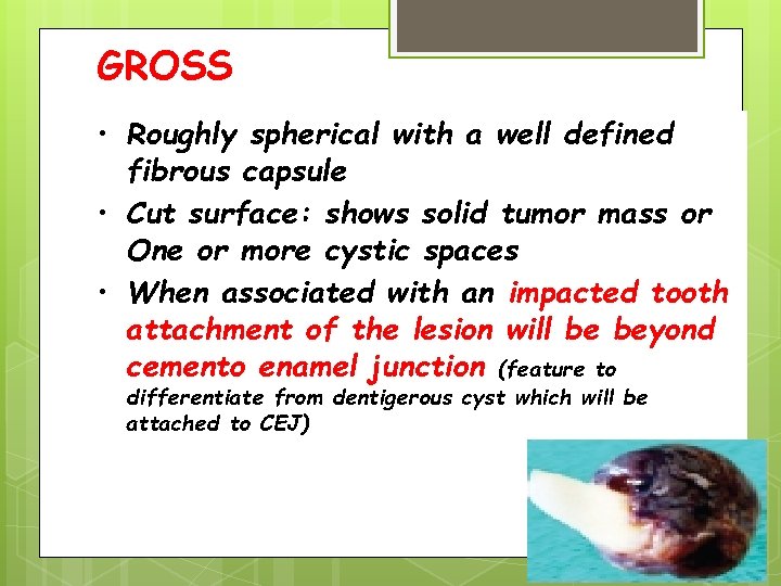 GROSS • Roughly spherical with a well defined fibrous capsule • Cut surface: shows