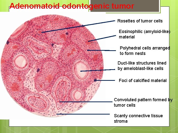 Adenomatoid odontogenic tumor Rosettes of tumor cells Eosinophilic (amyloid-like) material Polyhedral cells arranged to