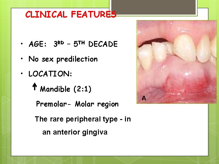 CLINICAL FEATURES • AGE: 3 RD – 5 TH DECADE • No sex predilection