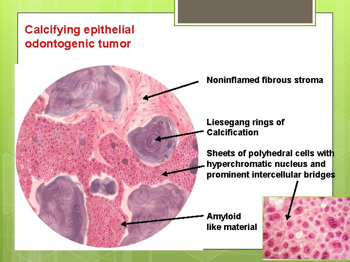 Calcifying epithelial odontogenic tumor Noninflamed fibrous stroma Liesegang rings of Calcification Sheets of polyhedral