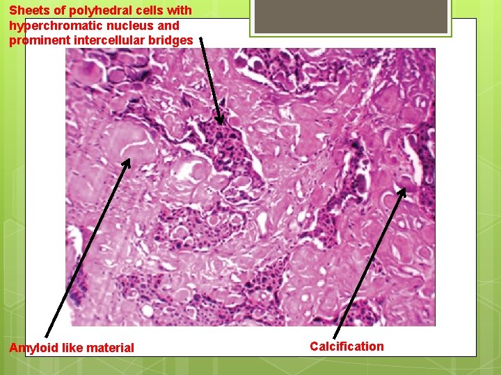 Sheets of polyhedral cells with hyperchromatic nucleus and prominent intercellular bridges Amyloid like material