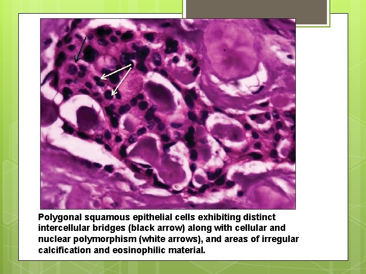 Polygonal squamous epithelial cells exhibiting distinct intercellular bridges (black arrow) along with cellular and