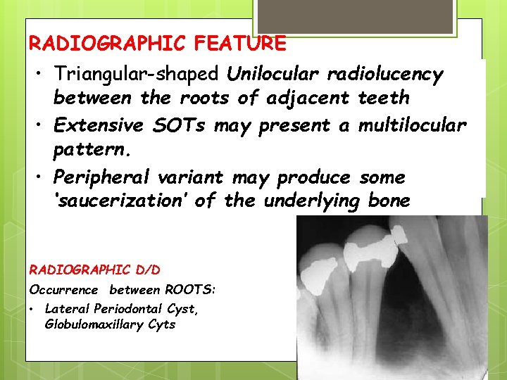 RADIOGRAPHIC FEATURE • Triangular-shaped Unilocular radiolucency between the roots of adjacent teeth • Extensive
