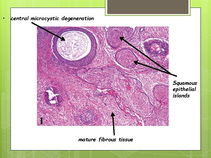  • central microcystic degeneration Squamous epithelial islands mature fibrous tissue 