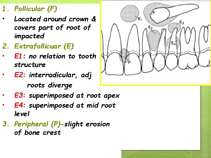 1. Follicular (F) • Located around crown & covers part of root of impacted