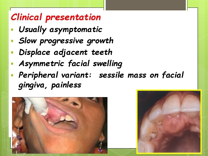 Clinical presentation Usually asymptomatic Slow progressive growth Displace adjacent teeth Asymmetric facial swelling Peripheral