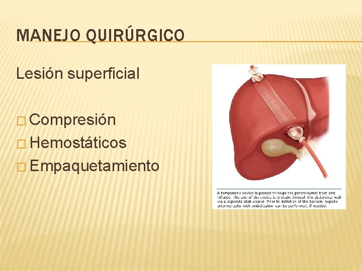 MANEJO QUIRÚRGICO Lesión superficial � Compresión � Hemostáticos � Empaquetamiento 