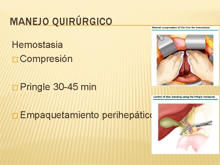 MANEJO QUIRÚRGICO Hemostasia � Compresión � Pringle 30 -45 min � Empaquetamiento perihepático 