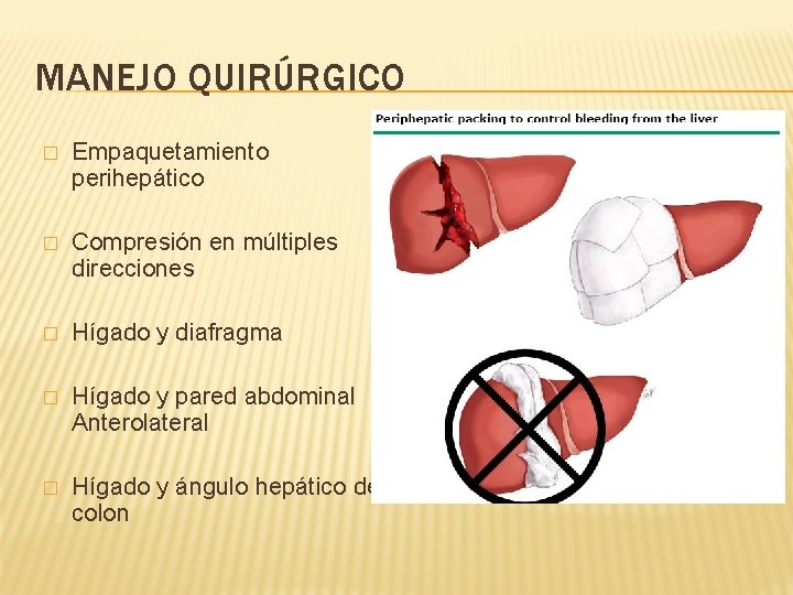 MANEJO QUIRÚRGICO � Empaquetamiento perihepático � Compresión en múltiples direcciones � Hígado y diafragma