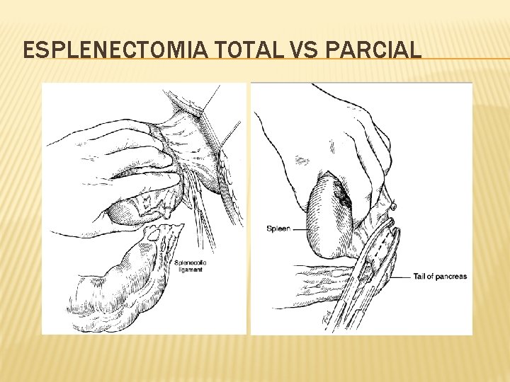 ESPLENECTOMIA TOTAL VS PARCIAL 