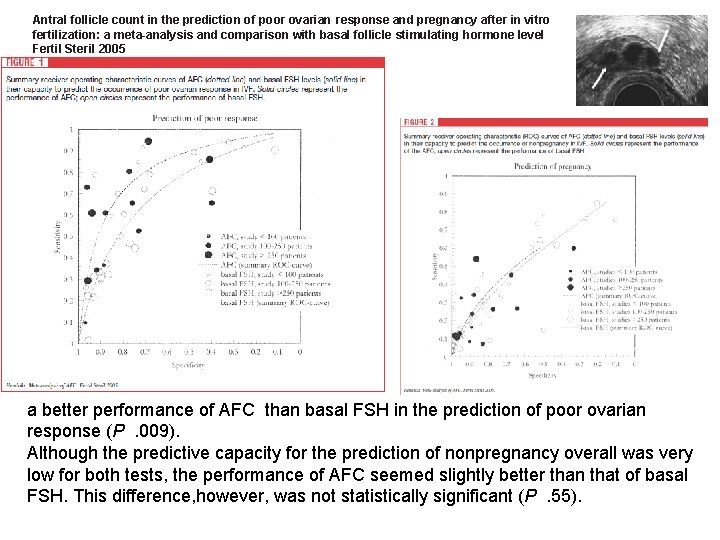 Antral follicle count in the prediction of poor ovarian response and pregnancy after in