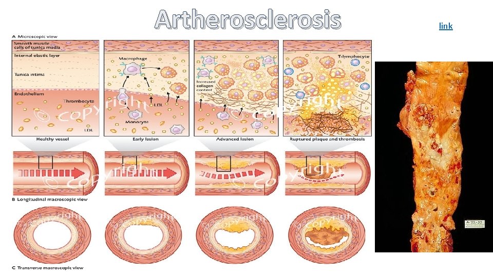 Artherosclerosis link 