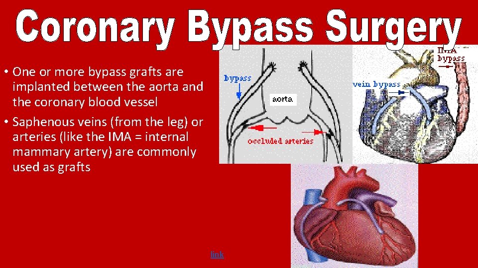  • One or more bypass grafts are implanted between the aorta and the