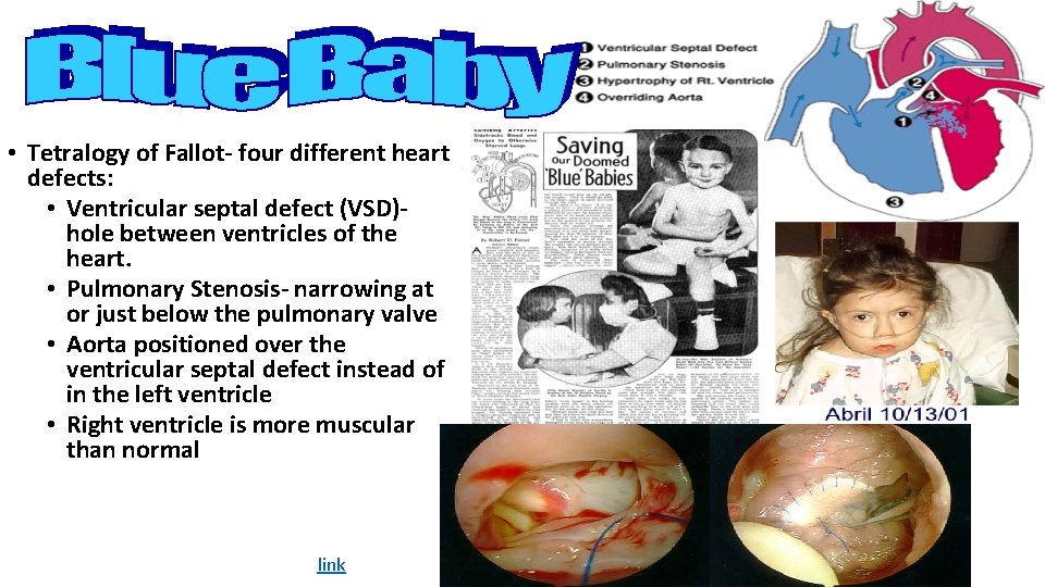  • Tetralogy of Fallot- four different heart defects: • Ventricular septal defect (VSD)hole