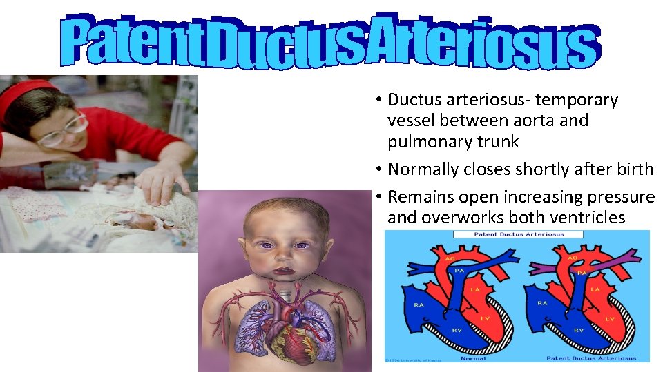  • Ductus arteriosus- temporary vessel between aorta and pulmonary trunk • Normally closes