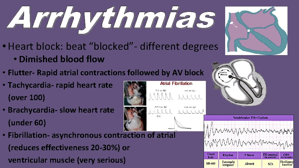  • Heart block: beat “blocked”- different degrees • Dimished blood flow • Flutter-