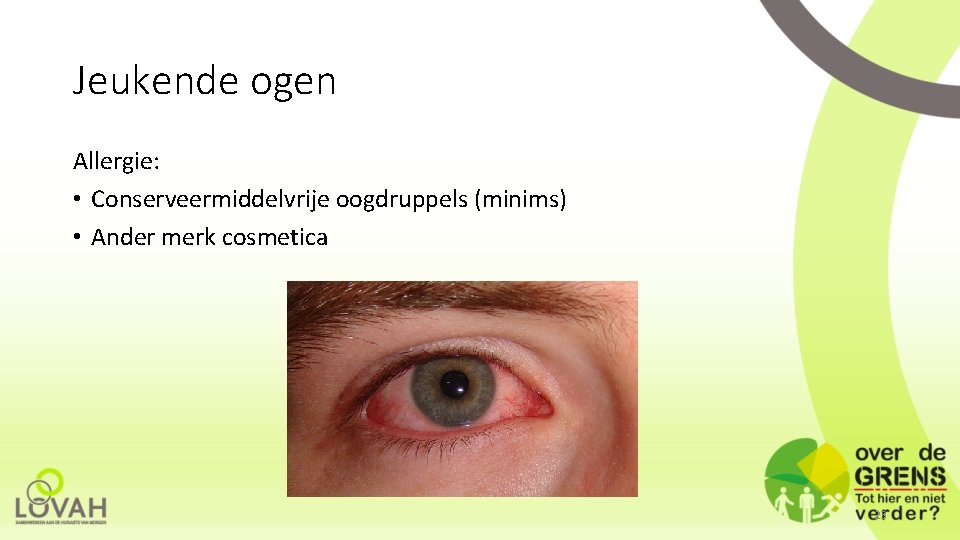 Jeukende ogen Allergie: • Conserveermiddelvrije oogdruppels (minims) • Ander merk cosmetica 23 