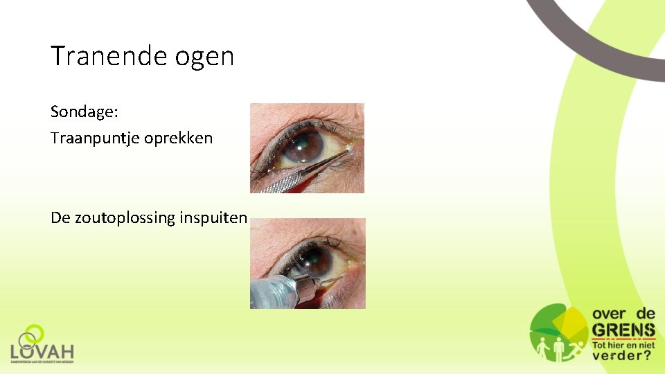 Tranende ogen Sondage: Traanpuntje oprekken De zoutoplossing inspuiten 8 