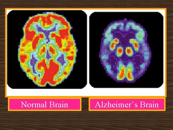 Normal Brain Alzheimer’s Brain 