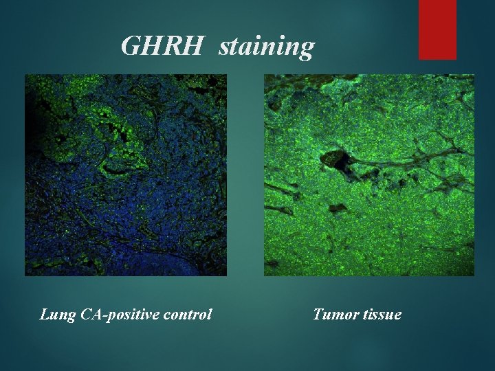 GHRH staining Lung CA-positive control Tumor tissue 