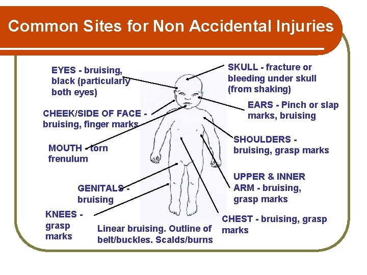 Common Sites for Non Accidental Injuries EYES - bruising, black (particularly both eyes) CHEEK/SIDE